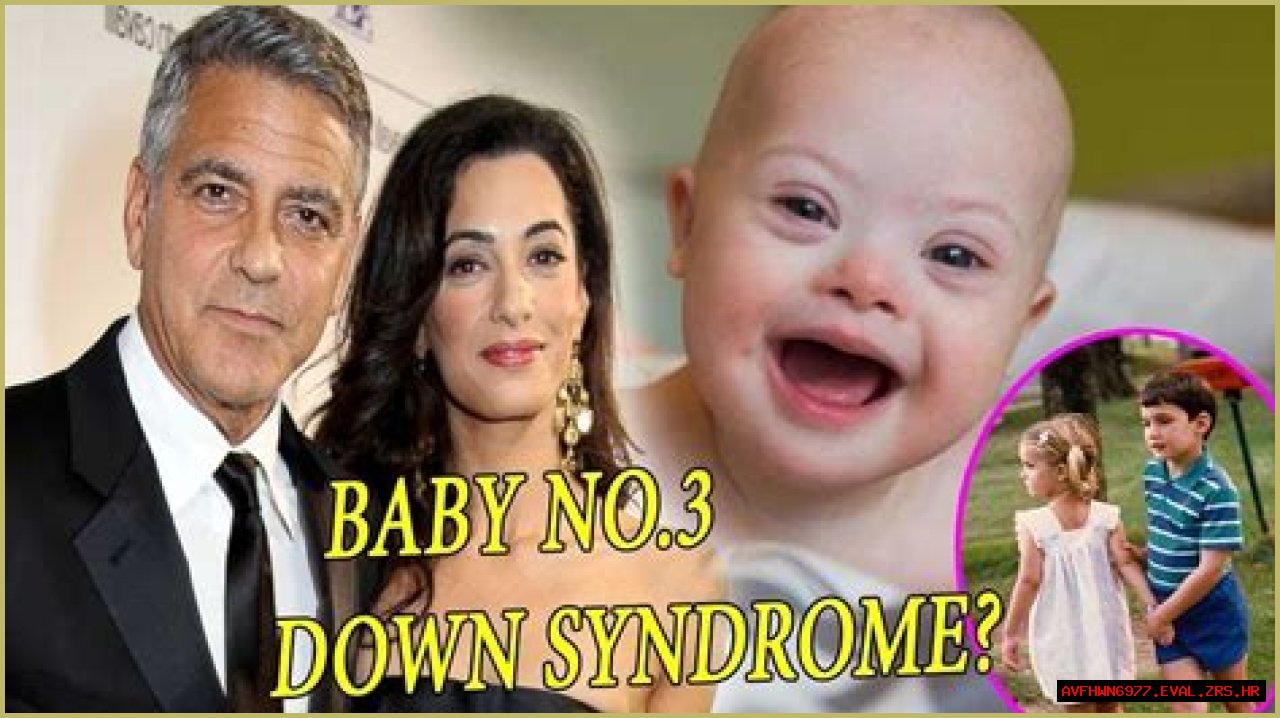 George Clooney's Son: Navigating Life With Down Syndrome