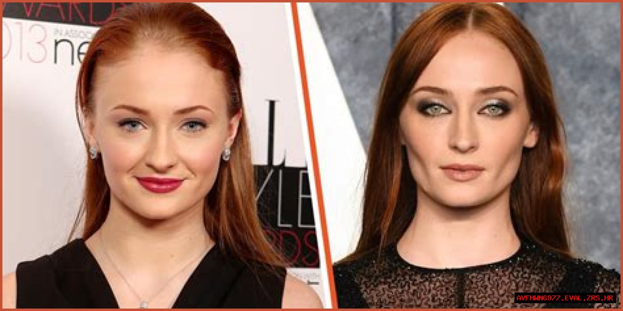 Unveiling The Transformation: Sophie Turner And Buccal Fat Removal